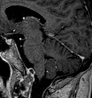 Clival Chondrosarcoma Associated With an Intra-Axial Cystic Medullary Lesion Responsive to Steroids